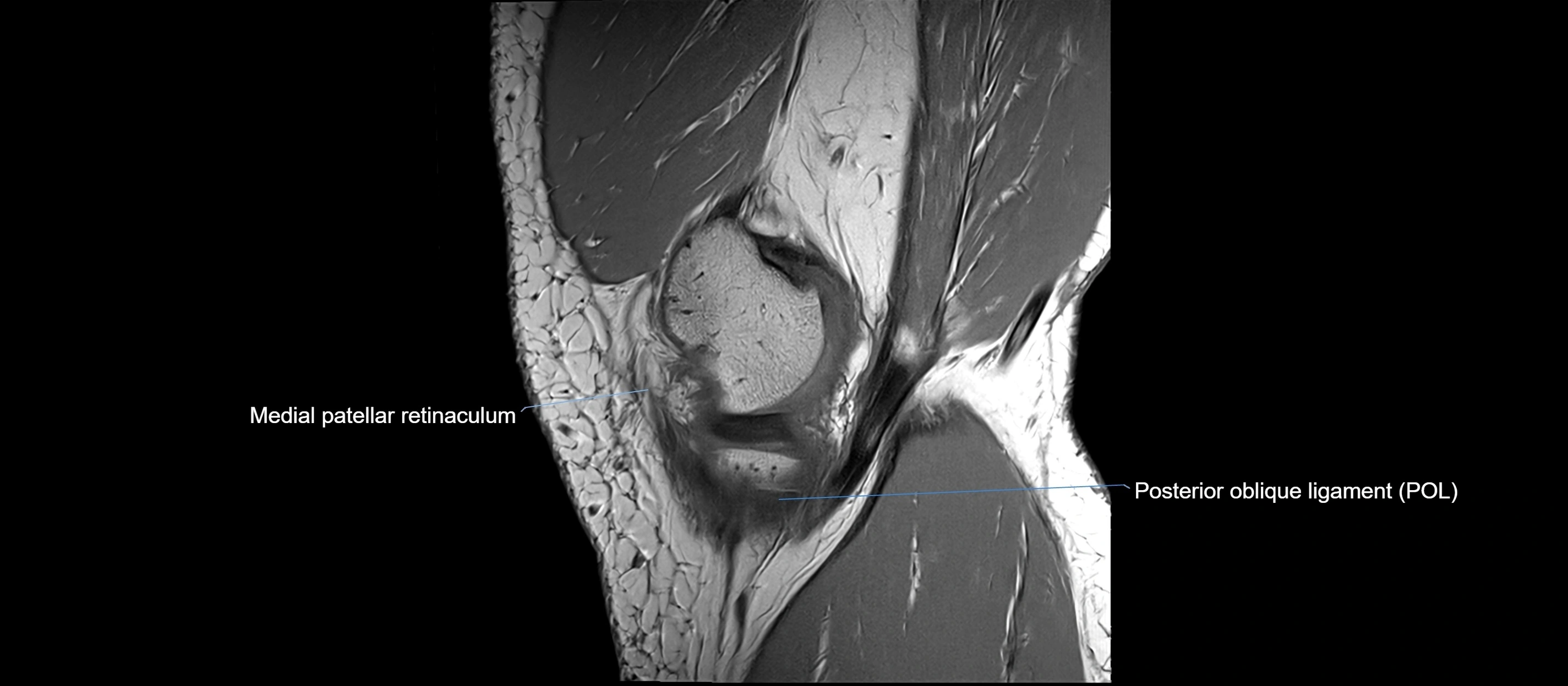 MRI sagittal  ligaments cross sectional anatomy 3T  radiology  image-img-00001-00010.webp